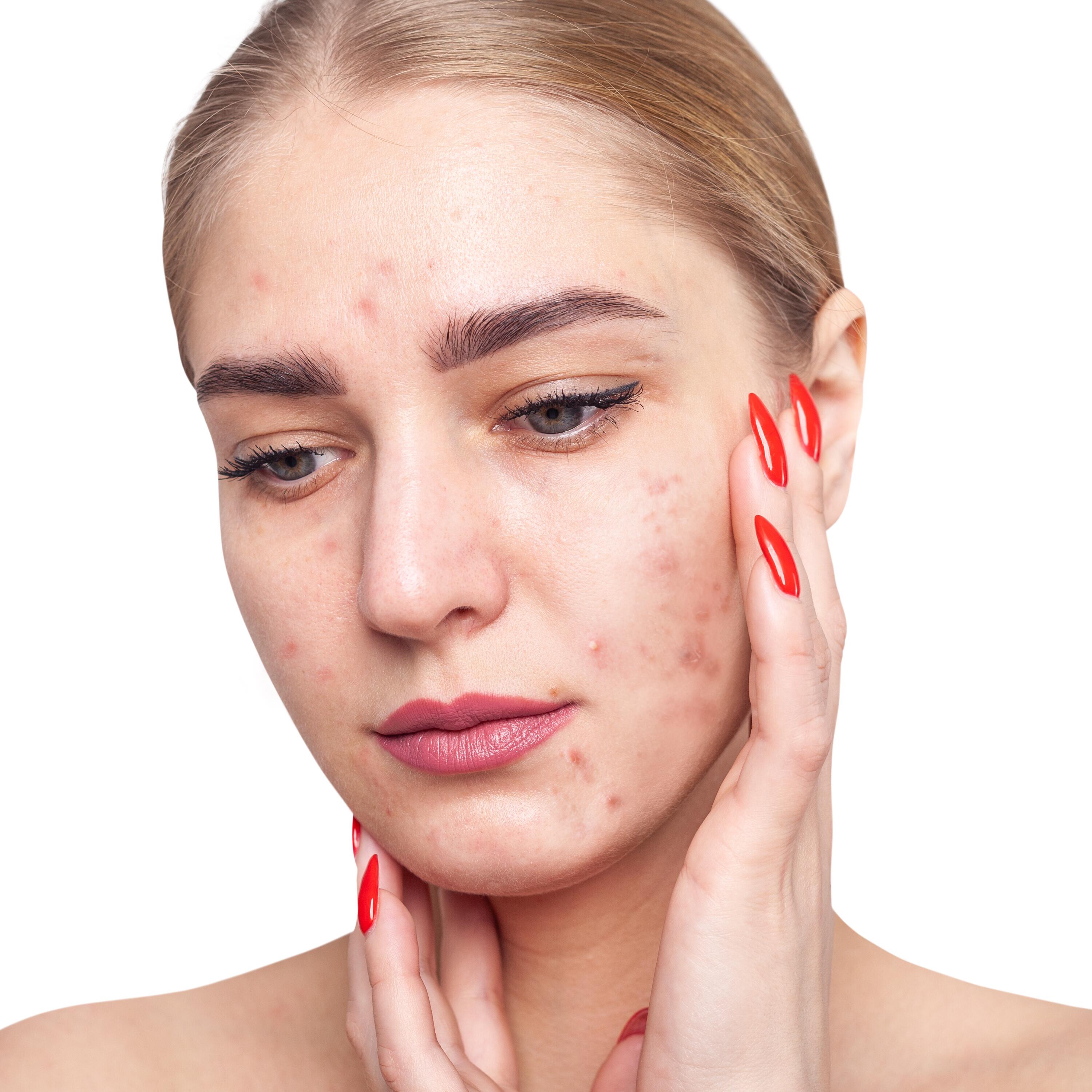 Acne bij volwassenen: oorzaken en behandelingen